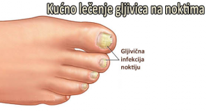 gljivicne-infekcije-noktiju-1